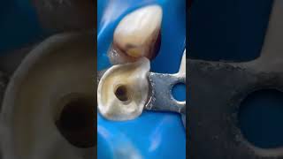 Endodontic drabdullahsultandentist اسنان اكسبلور dentist satisfying bestdentist expertdent [upl. by Nallek687]