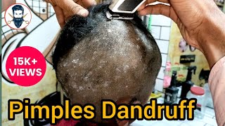 Head shaved pimples and dandruff treatment 👩‍🦲 most head shave baby [upl. by Geffner]