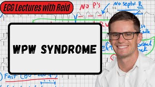 WolffParkinsonWhite Syndrome  Day 17 ECG Challenge [upl. by Gazo750]