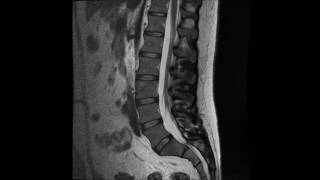 MR undersøkelse av normal korsrygg Normal lumbal columna [upl. by Croix]