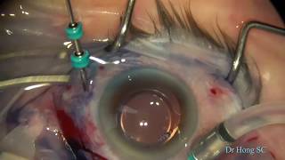 ERM Epiretinal membrane peeling surgical removal [upl. by Nananne]