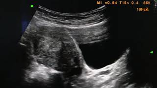 Retained products of conception USG Ultrasound [upl. by Hayilaa]