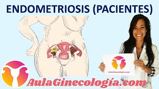 ENDOMETRIOSIS PACIENTES Síntomas diagnóstico tratamiento fertilidad Ginecología y Obstetricia [upl. by Sadiras]