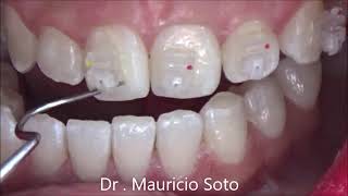 Orthodontic Brackets Bonding step by step [upl. by Claman]