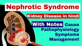 Nephrotic syndrome  causepathologysymptoms  kidney disease  medical surgical nursing lecture [upl. by Naashom933]