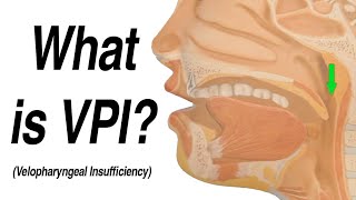 Velopharyngeal Insufficiency VPI Causing Hypernasal Speech and Nasal Regurgitation with Swallow [upl. by Oiramel]