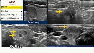 How to calculate TIRADS score for thyroid lesion Thyroid Ultrasound Part II [upl. by Dich]