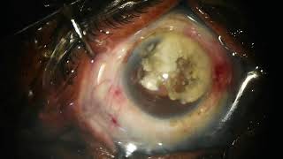 Extracapsular cataract Extraction [upl. by Sapers615]