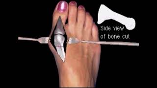 Austin bunionectomy with Akin osteotomy Moderate bunion correction surgery [upl. by Idnahc]