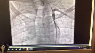 Subclavian Steal Syndrome [upl. by Cl]