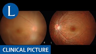 HTLV1 uveitis and Graves’ disease [upl. by Nylle]