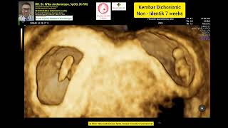 7 Weeks Dichorionic Twins [upl. by Eseerahs]