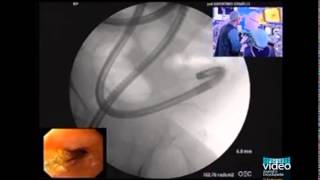 Enteroscopic Balloon Dilation of Multiple Ileal Strictures in Suspected Crohns Disease [upl. by Ansev]