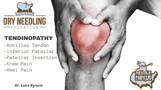 Tendinitis and Tendinopathy Dry Needling Treatment Protocol [upl. by Hcahsem924]