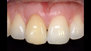 DRendo  Retreatment and endodontic bleaching of a maxillary central incisor [upl. by Yllek485]