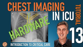 Chest Imaging in ICU  Part 2  Hardware [upl. by Epuladaugairam]