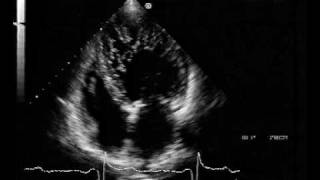 echocardiogram  LV Non compaction [upl. by Hooge]