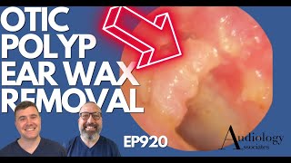 OTIC POLYP EAR WAX REMOVAL  EP920 [upl. by Bhatt]