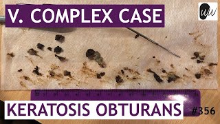 V COMPLEX CASE Keratosis Obturans Removal  356 [upl. by Artenra]