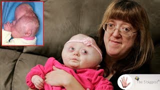 The girl with cloverleaf head Before and after surgery pictures  Body Bizarre [upl. by Schug]