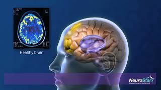 What is the Mechanism of Action in NeuroStar TMS Therapy [upl. by Babara148]