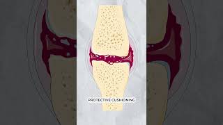 Osteoarthritis vs Osteoporosis [upl. by Erin30]