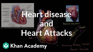 Heart disease and heart attacks  Miscellaneous  Heatlh amp Medicine  Khan Academy [upl. by Nosmoht]