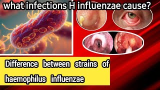 Haemophilus influenzae  Microbiology  What is the difference between strains bacteria [upl. by Kcinom]