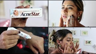 Acnestar Gel Review  HOW TO REALLY GET RID OF ACNE  SuperWowStyle Prachi [upl. by Birmingham]