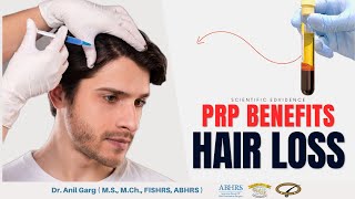 Control Hair Fall with PRP Treatment  Before amp After Result  Benefits of PRP [upl. by Annahahs]