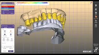 DENTAL DIGITAL DESIGN exocad [upl. by Ydnih705]