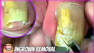 Cutting this Long Ingrown Toenail by Podiatrist  Treatment amp How to remove  get rid of it PEDICURE [upl. by Leirol]