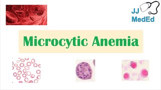 Microcytic Anemia amp Causes Iron Deficiency Thalassemia Anemia of Chronic Disease Lead Poisoning [upl. by Inverson]