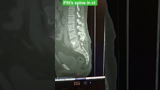 Potts spine mri ct shorts viral viralvideo potts [upl. by Nnaeirelav]