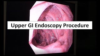 Upper GI Endoscopy Procedure in the ED [upl. by Ohs]