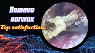 Top satisfaction Remove earwax [upl. by Toomay489]