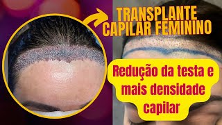 Fiz Transplante Capilar Feminino para redução de testa e densidade capilar Valores Como é feito [upl. by Aeki]