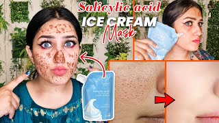 Does This Salicylic Acid ice cream Mask Work  Salicylic acid ice cream mask [upl. by Ennahtur93]