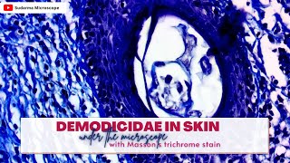 Demodicidae in skin under the microscope with Massons trichrome stain [upl. by Necyla352]