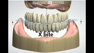 Crossbite setup in 3Shape [upl. by Sirraf]