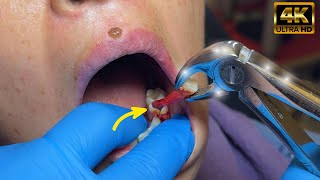 Abscessed Tooth Extraction in 1 MIN or less in 4K [upl. by Belicia]