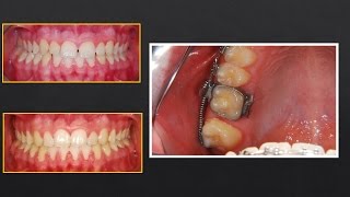 Molar distalization in Orthodontic Treatment Orthodontics [upl. by Strepphon]