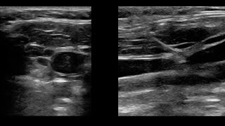 Transvenous Pacemaker Placement by Ultrasound 82020 [upl. by Rheingold]