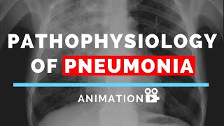 Pathophysiology of Pneumonia  Animation  Made Easy [upl. by Akiria]