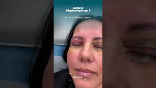 Blepharoplasty surgery eyelid  Doctor Levy Romania plastic surgeon [upl. by Gran523]