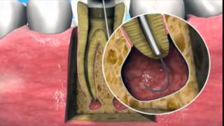 Nonsurgical management of periapical lesions [upl. by Einaffit]