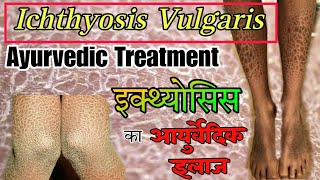 Ichthyosis Vulgaris Ayurvedic Treatment  Fish Scale Disease  Dr Mohammad Azam  इक्थ्योसिस [upl. by Ainuj]