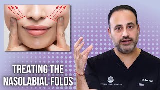 Treating the Nasolabial Folds  Lesson of the Day [upl. by Francisco]