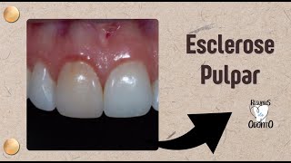 ESCLEROSE PULPAR  RESUMOS DE ODONTO [upl. by Deehan166]