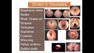 flexible laryngoscopy in congenital stridor [upl. by Sudbury]